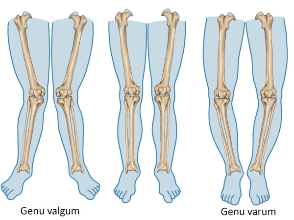 Genu Valgum Age Genu Valgum Winkel IIOMI Genu Valgum Age Genu Valgum Winkel IIOMI