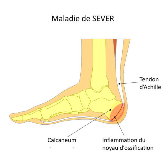 Le louedec Podologue Saint Grégoire Rennes, maladie de Sever. — free download