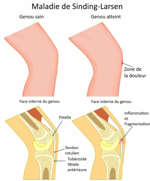 Vector illustration of a healthy adolescent knee and unhealthy k