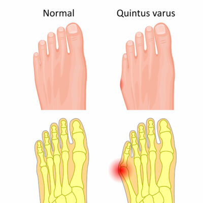Illustration of the normal foot and Tailor's bunion. External an
