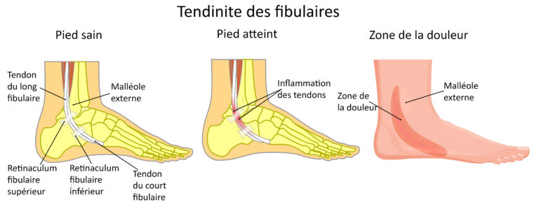 Le louedec | TENDINITE FIBULAIRE