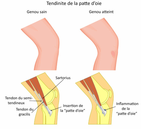Vector illustration of a healthy knee and unhealthy knee with Su