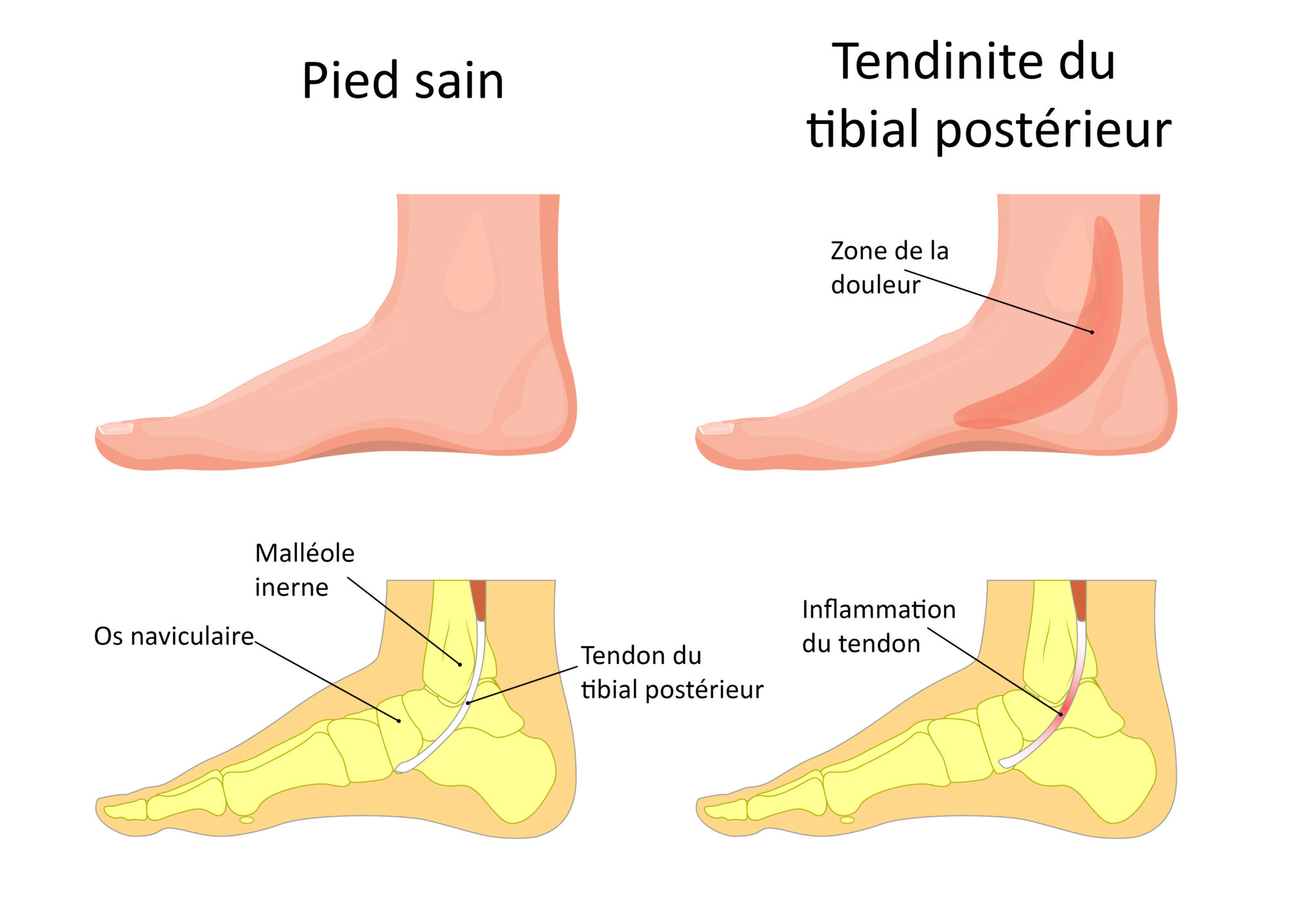 Le Louedec Tendinite Du Tibial PostÉrieur 8607