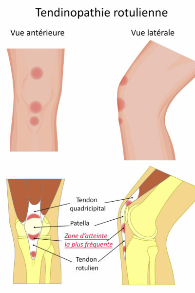 tendinopathie rotulienne image